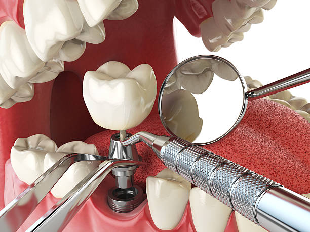 Best Emergency Dental Care for Abscessed Tooth in South Dennis, MA